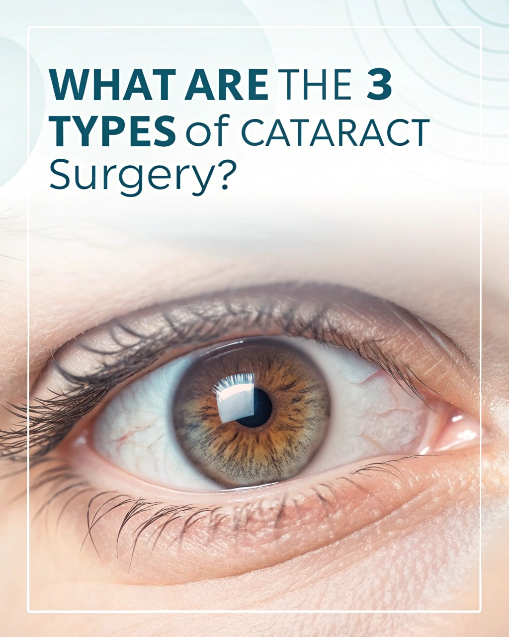 What Are the 3 Types of Cataract Surgery?